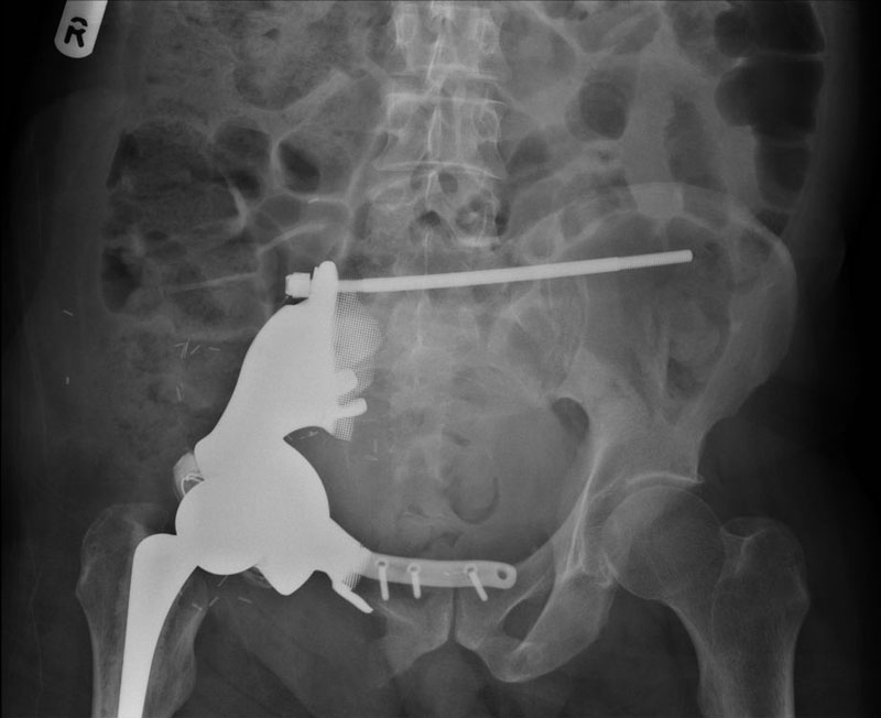 Fig 12. Implant in situ